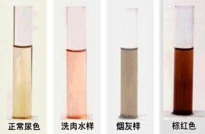宝宝易中招的几种肾病常见症状